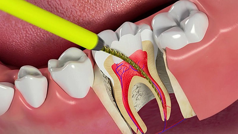 Sau khi chữa tủy nha sĩ sẽ phục hồi lại thân răng