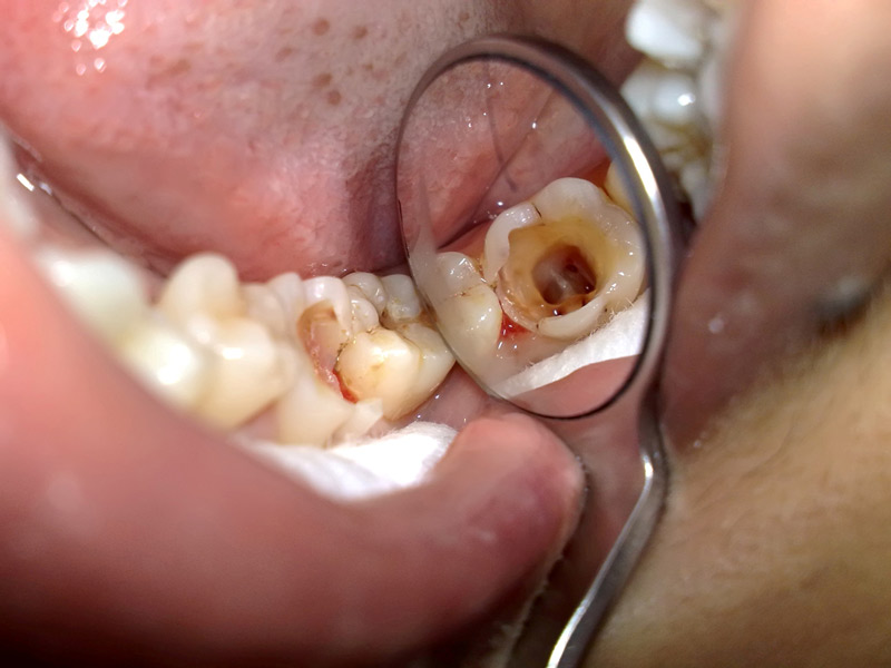 Việc rút tủy răng diễn ra vô cùng nhẹ nhàng và không đau đớn
