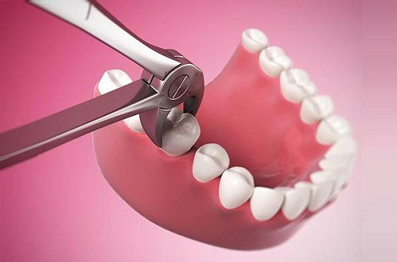Tùy trường hợp bạn có thể phải nhổ răng khi chữa tủy