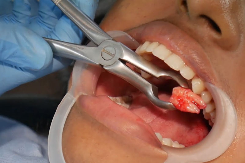 Quy trình nhổ răng khôn cần được thực hiện bởi bác sĩ chuyên khoa