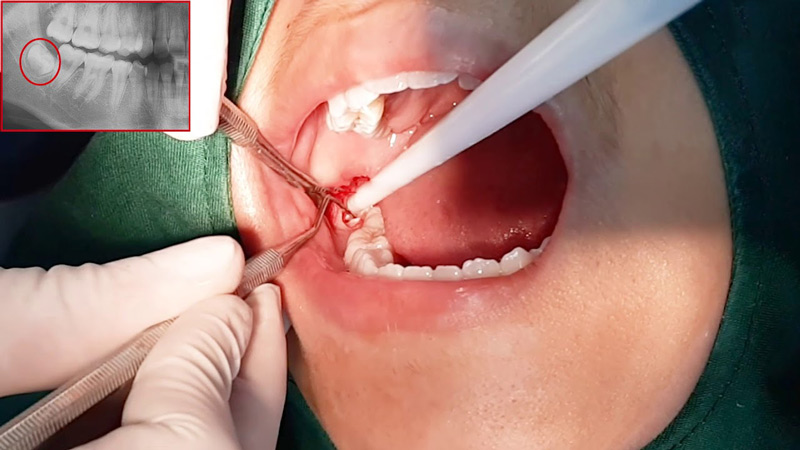 Nhổ răng khôn được chỉ định khi nó gây biến chứng nguy hiểm