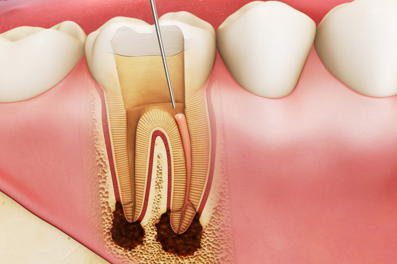 Viêm tủy răng là tình trạng tủy và các mô xung quanh chân răng bị viêm nhiễm