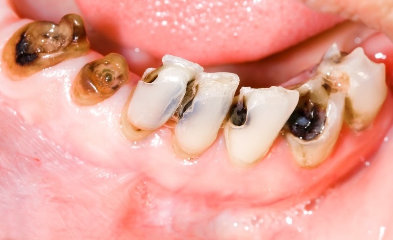 Sâu răng là nguyên nhân khiến tủy răng bị viêm