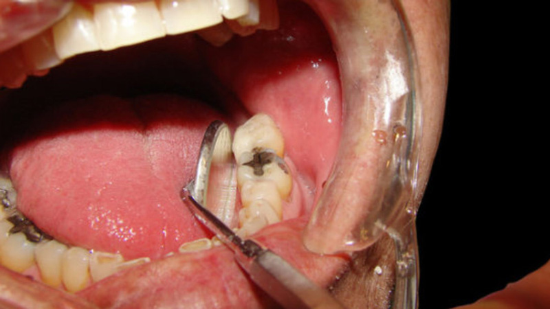 Viêm tủy răng cấp có thể gây ra những biến chứng nguy hiểm