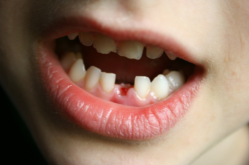 Mất răng là một trong những ảnh hưởng do viêm tủy gây ra