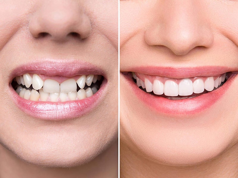 Bọc răng sứ giúp hàm răng trắng sáng, đều đẹp hơn