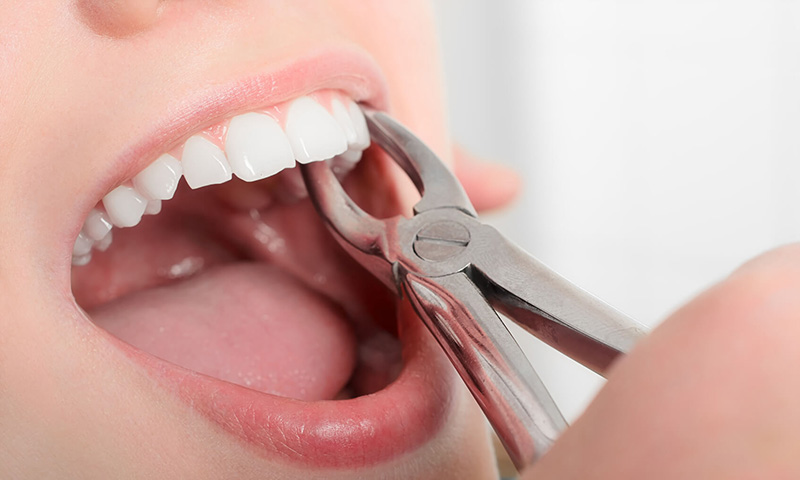 Phương pháp nhổ răng khôn hàm trên bằng kìm