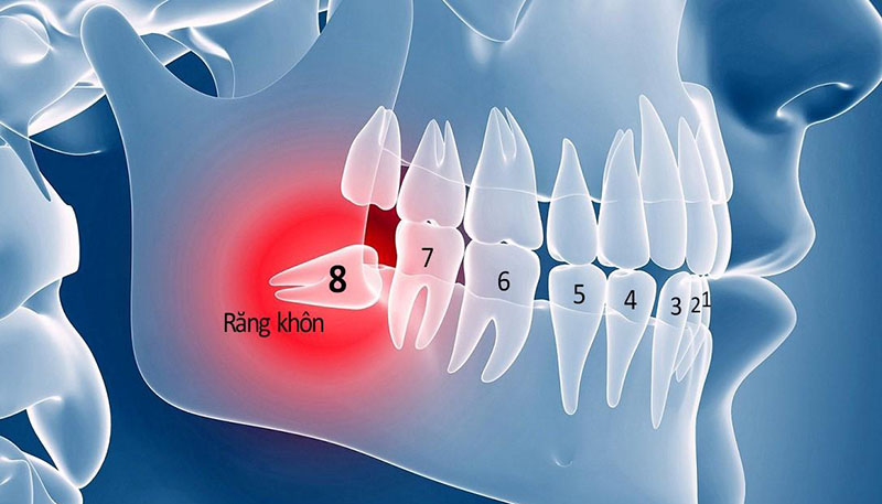 Quy trình nhổ răng khôn không đảm bảo có thể gây ra nhiều biến chứng