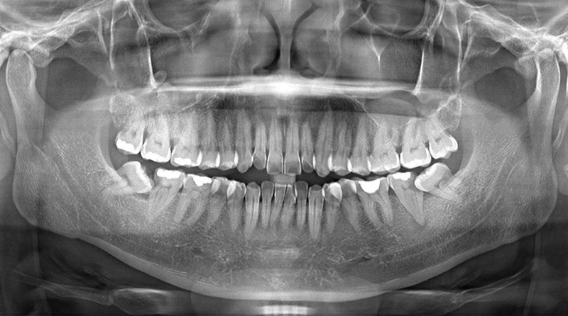 Răng khôn mọc lệch thường kèm theo những cơn đau âm ỉ
