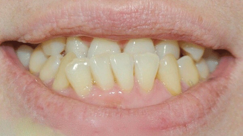 Niềng răng mắc cài kim loại với răng mọc lệch, không thẳng hàng