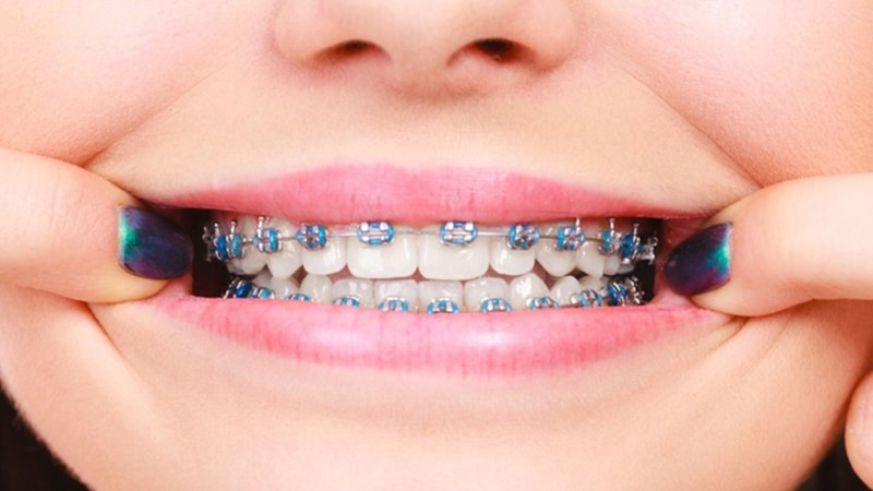 Niềng răng mắc cài kim loại là phương pháp được dùng phổ biến hiện nay