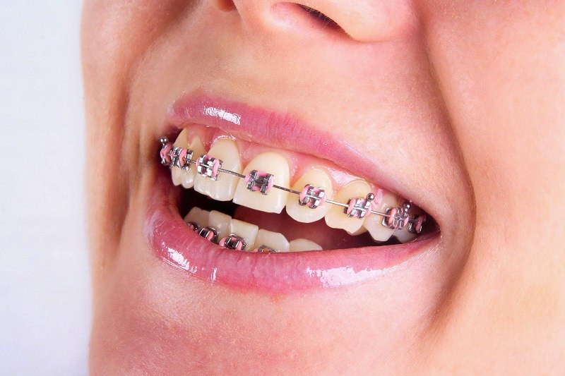 Niềng răng mắc cài kim loại giúp bạn sớm sở hữu nụ cười rạng rỡ