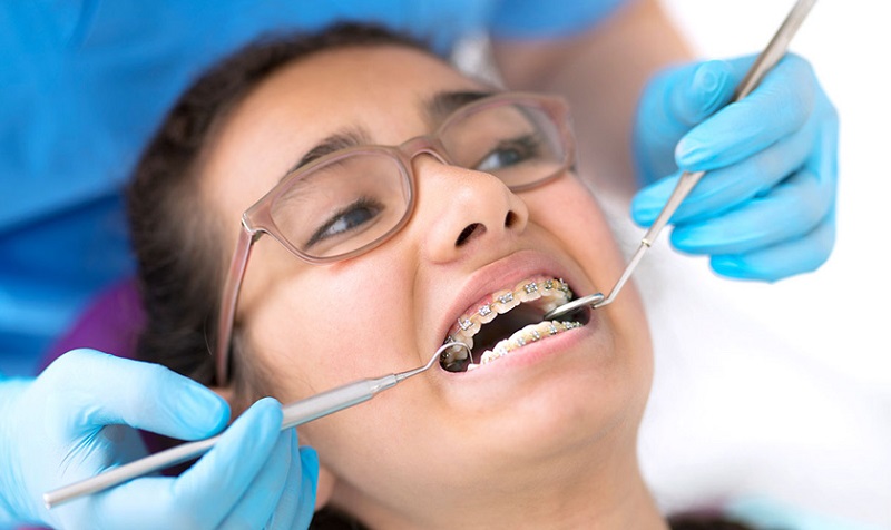 Chi phí niềng răng còn phụ thuộc vào rất nhiều yếu tố