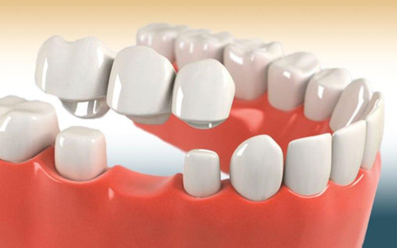 Trồng răng hàm giá bao nhiêu phụ thuộc vào chất lượng và cách thức thực hiện