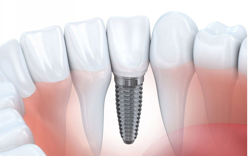 Tìm Hiểu] Trồng Răng Implant Giá Rẻ Ở Tại TPHCM Có Tốt Không?