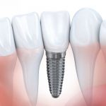 [Tìm Hiểu] Trồng Răng Implant Giá Rẻ Ở Tại TPHCM Có Tốt Không?