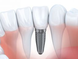 [Tìm Hiểu] Trồng Răng Implant Giá Rẻ Ở Tại TPHCM Có Tốt Không?