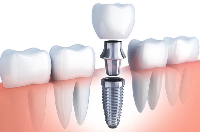 Trồng răng Implant là kỹ thuật nha khoa phức tạp nên cần thực hiện ở nha khoa uy tín