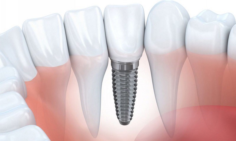 Trồng răng Implant là một kỹ thuật nha khoa phức tạp