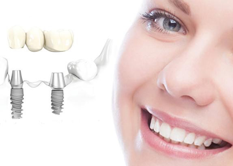 Trồng răng khểnh có thể giúp bạn có nụ cười duyên dáng hơn