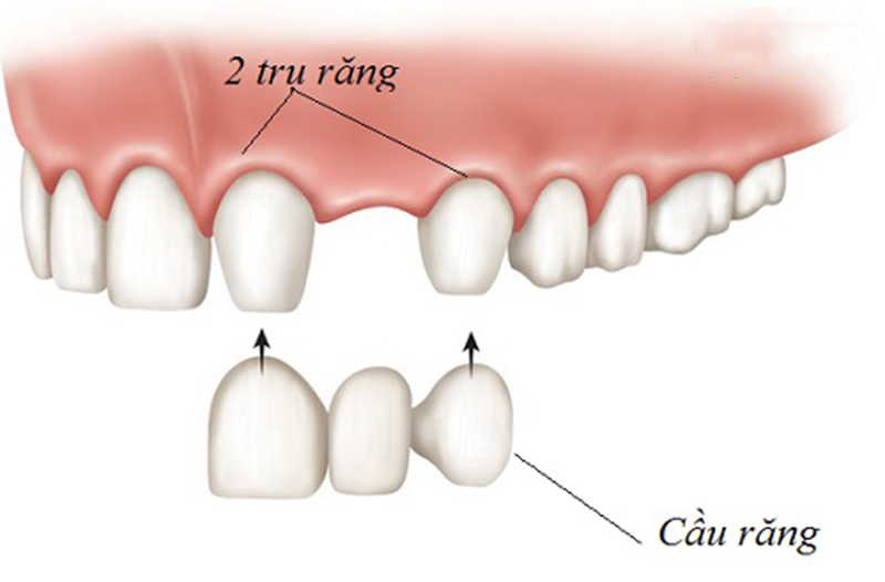 Trồng răng khểnh bằng phương pháp bọc răng sứ
