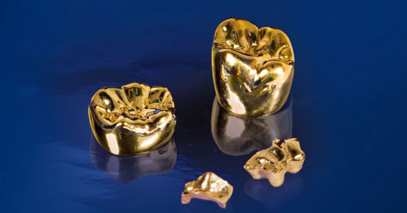 Răng vàng còn được gọi là răng sứ quý kim