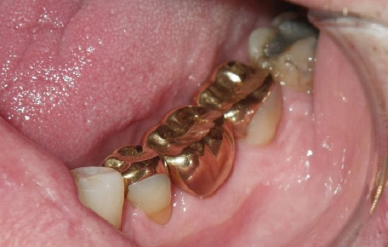 Trồng răng vàng không lo lắng hiện tượng đổi màu răng