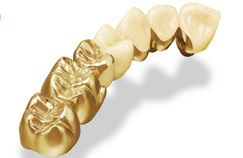 Làm cầu răng sứ bằng vàng cần mài 2 răng kế cận