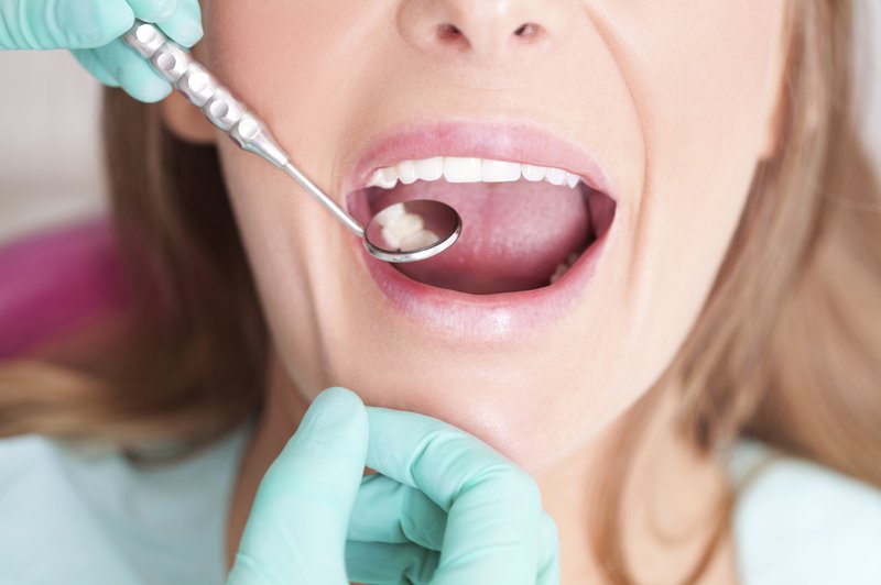 Tình trạng răng miệng là yếu tố quyết định đến giá trồng răng