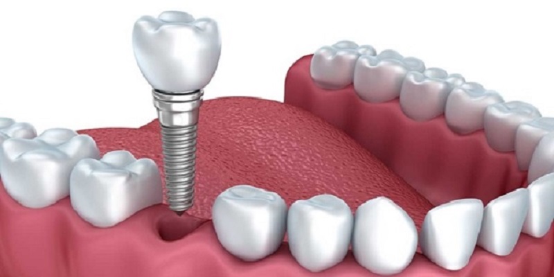 Trồng răng giả có ảnh hưởng gì không phụ thuộc vào nhiều yếu tố