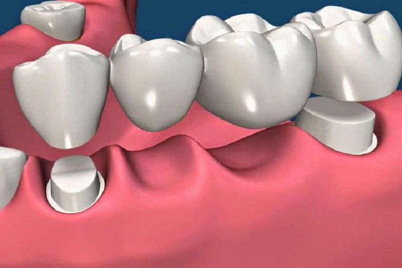 Trồng răng giả cố định là giải pháp phục hình răng được ứng dụng phổ biến