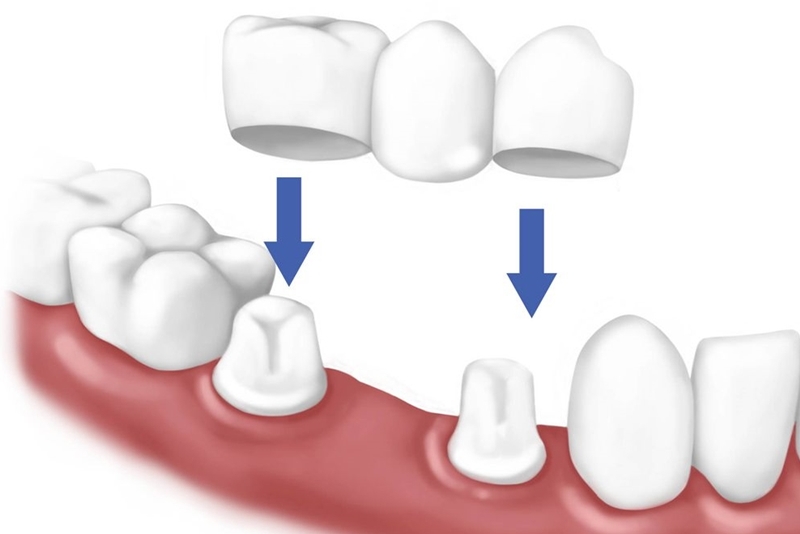 Trồng răng giả cố định bằng phương pháp cầu răng sứ có chi phí thấp
