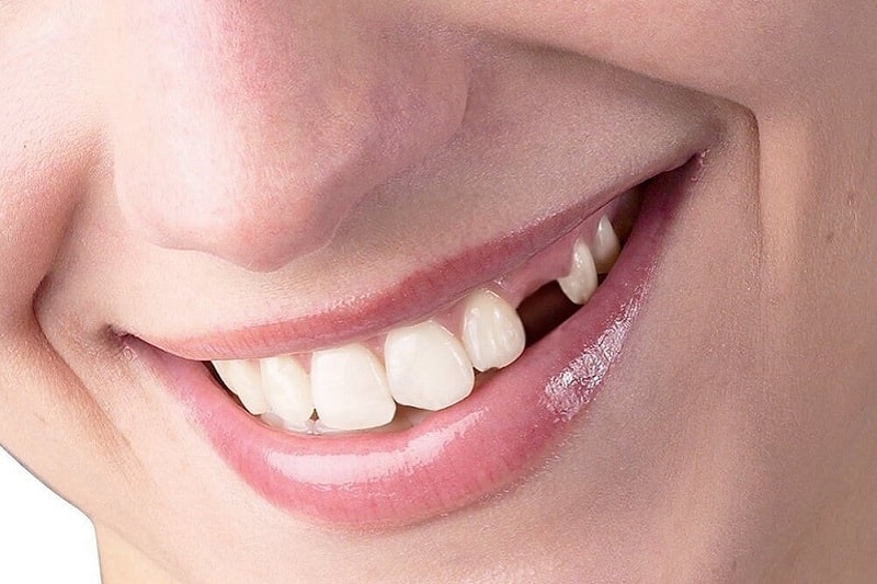 Nhổ răng không trồng lại có sao không được nhiều người quan tâm