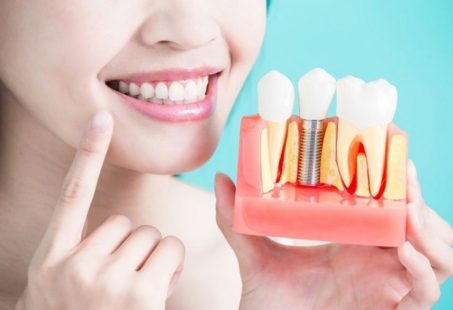 Nhổ răng không trồng lại có sao không và những điều cần lưu ý