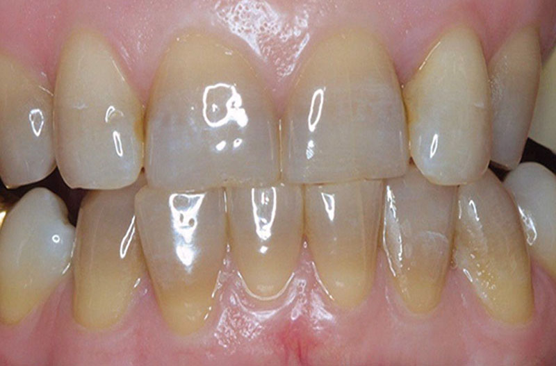 Phương pháp được áp dụng với các trường hợp răng ố vàng, nhiễm màu...