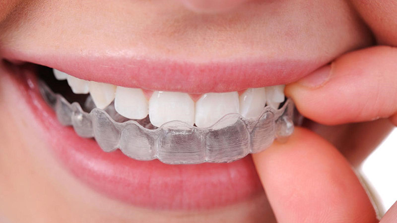 Dùng máng làm trắng răng tại nhà là cách được nhiều người lựa chọn