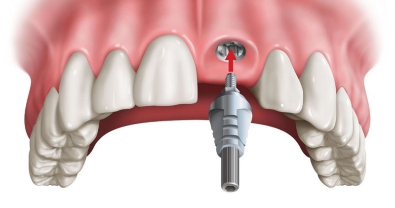 Cấy ghép trụ Implant là phương pháp phục hình răng phổ biến