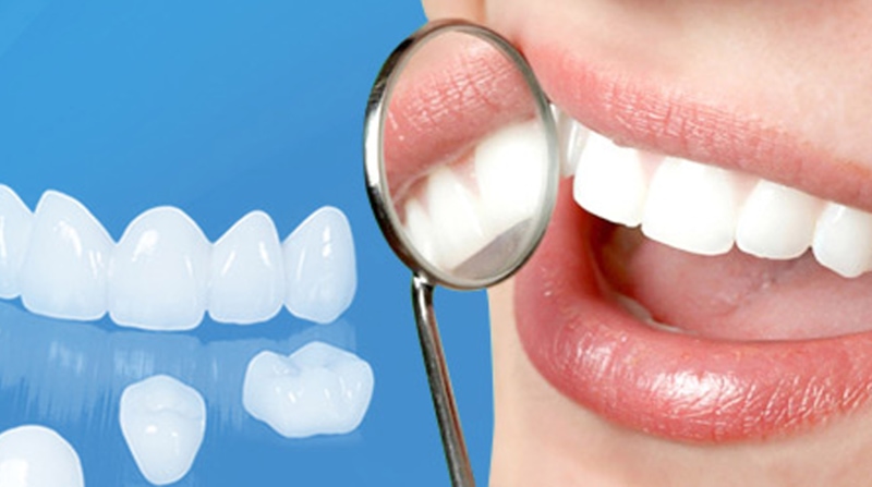 Giá của các phương pháp trồng răng cửa hầu hết đều phụ thuộc vào chất liệu răng