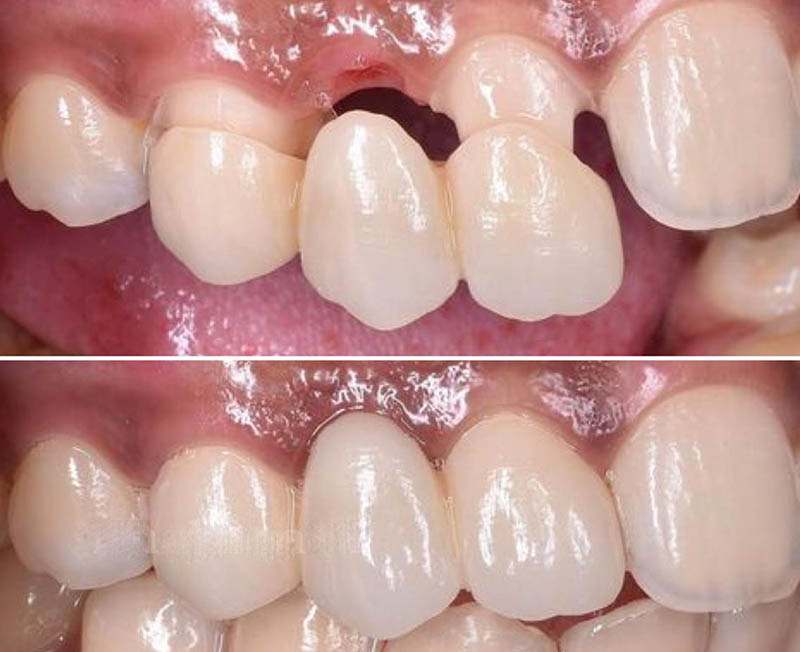 Thời gian có thể trồng răng sau khi mất răng phụ thuộc vào từng phương pháp
