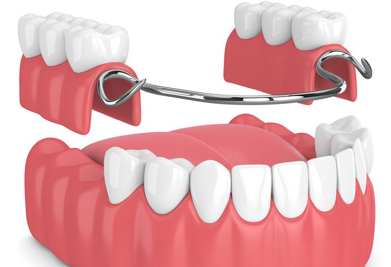 Hàm khung tháo lắp phù hợp với người bị mất răng ở nhiều vị trí khác nhau