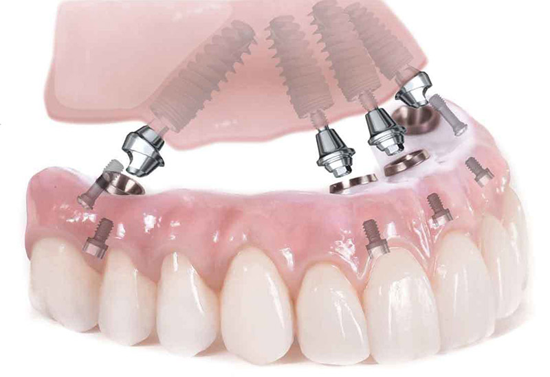Hàm răng giả tháo lắp trên trụ implant hạn chế tình trạng tiêu xương
