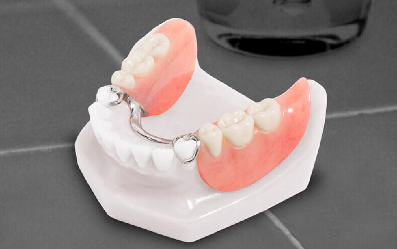 Quy trình phục hình răng giả sẽ mất từ 1 - 3 ngày
