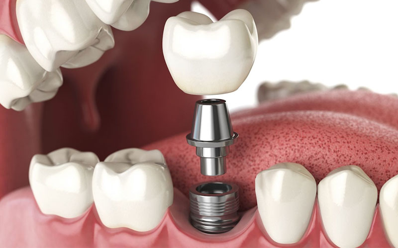 Trồng răng giả implant có ảnh hưởng gì đến sức khỏe không