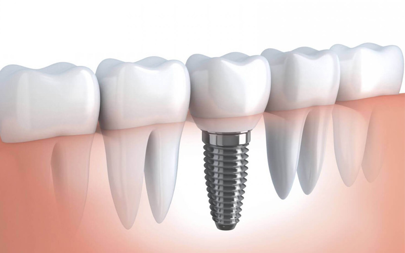 Cách giảm chi phí trồng răng implant