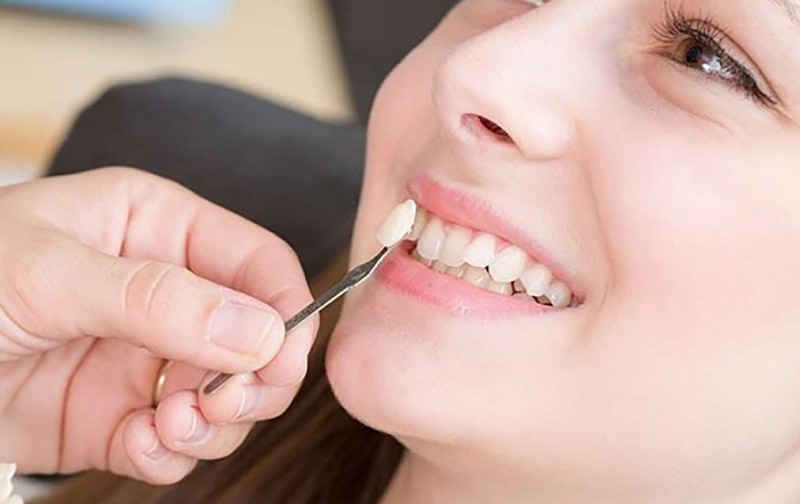 Đắp răng nanh bằng Composite là phương pháp tiết kiệm chi phí