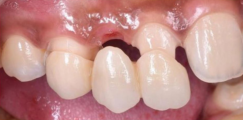 Cầu răng sứ giúp giải quyết vấn đề mất răng nanh