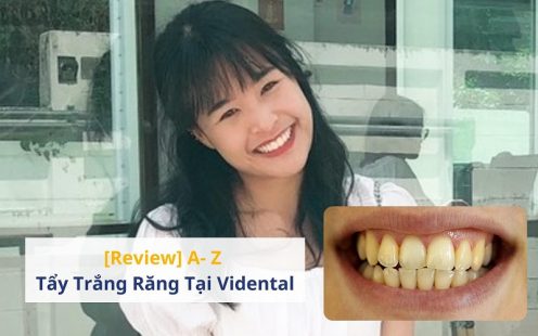 [Review] A- Z Tẩy Trắng Răng tại Trung Tâm ViDental Clinic
