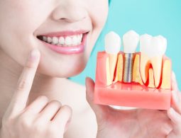 [Tìm hiểu] Trồng răng implant mất bao lâu để hoàn thành
