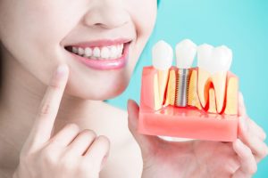 [Tìm hiểu] Trồng răng implant mất bao lâu để hoàn thành