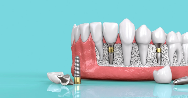 Trồng răng Implant mất bao lâu là vấn đề nhiều người băn khoăn